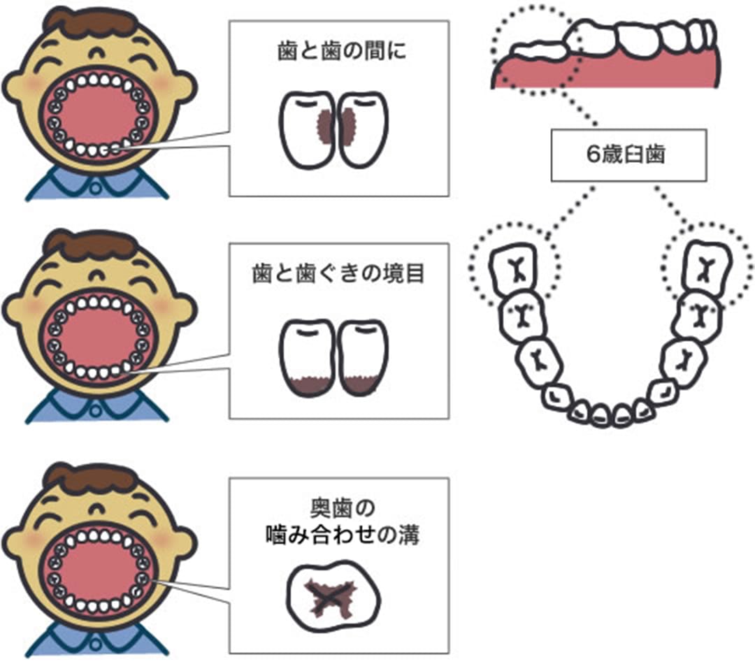 むし歯になりやすいところは？