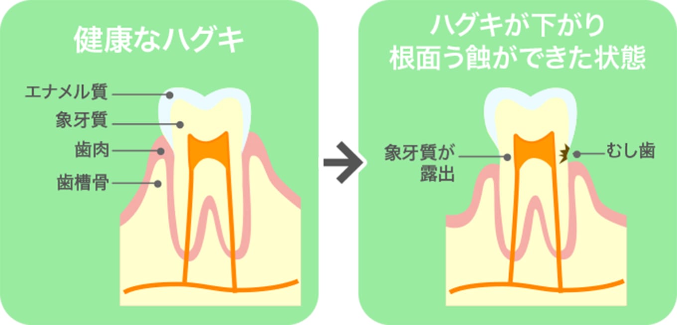 シニアのむし歯は手ごわい